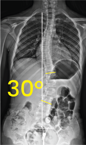 Omurga eğriliğini ve 30 derece açıyı gösteren iskeletin göğüs-karın röntgeni.