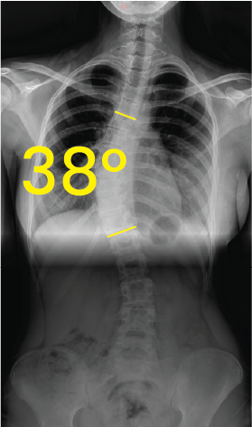 Göğüs röntgeninde omurgada 38 derece skolyoz açısını gösteren sarı çizgiler ve 38° rakamı.