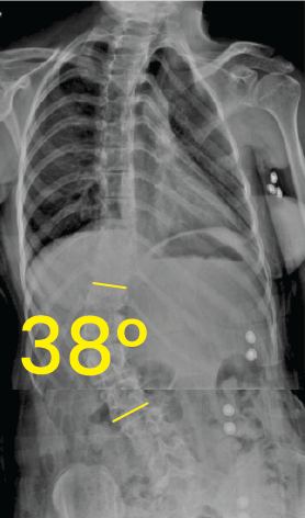 Torakal omurga röntgeninde 38 derece skolyoz açısı ve omurgada metal vida yerleşimi.
