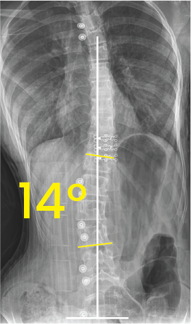 X-ray image of a human torso showing the spine with surgical implants and a 14-degree curvature marked.