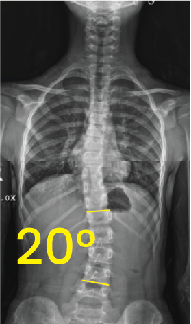 Göğüs ve bel bölgesinde 20 derece eğimli skolyozu gösteren X-ışını omurga röntgeni.