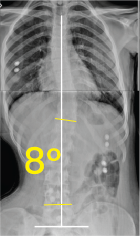 Göğüs ve karın bölgesinin iki farklı açıyla çekilmiş röntgen görüntüsü ve üzerinde 8 derece açı gösteren sarı işaret.