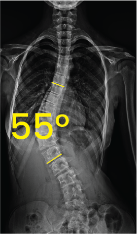 Omurga eğriliğini gösteren 55 derece açıyla skolyozlu gövde röntgeni.