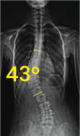 Göğüs bölgesinde 43 derece eğimli skolyozu gösteren omurga röntgeni görüntüsü.