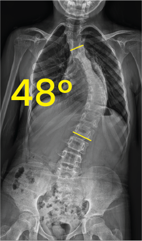 X-ray image of a human torso showing a 48-degree spinal curvature indicative of scoliosis.
