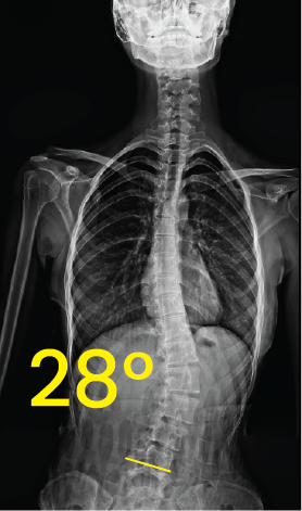 Dorsal X-ray image showing spinal curvature with a 28-degree angle measurement indicating scoliosis.