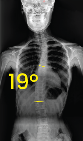 Göğüs ve omurga röntgeni, omurgada 19 derece eğrilik işaretiyle skolyoz gösteriyor.