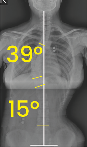 Göğüs ve bel bölgesinde 39° ve 15° eğim açılarını gösteren omurga röntgeni.