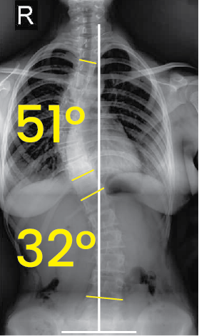 Belirgin 51° ve 32° dereceleri ile işaretlenmiş, omurgada eğriliği gösteren toraks ve karın bölgesi röntgeni.