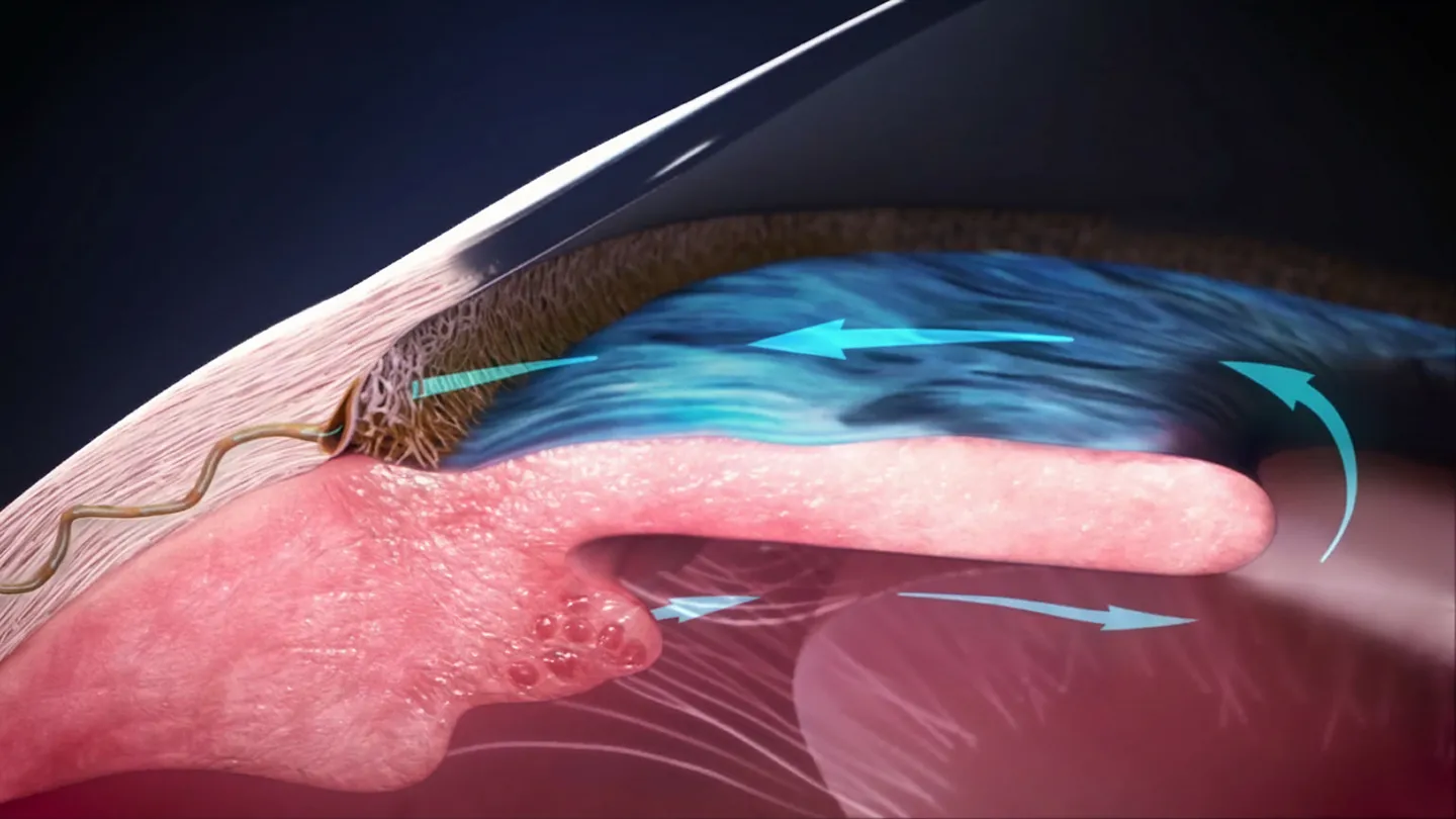 Canaloplasty infographic