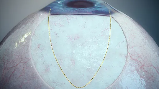 Ab Externo Procedure image