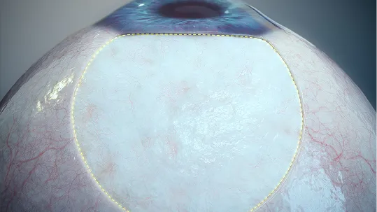 Ab Externo Procedure image