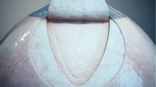 Ab Externo Procedure image