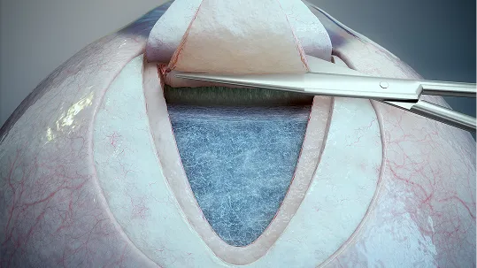 Ab Externo Procedure image