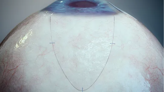 Ab Externo Procedure image