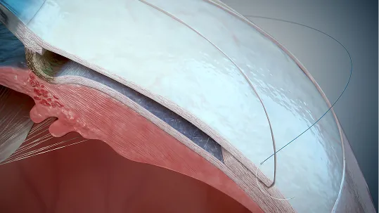 Ab Externo Procedure image