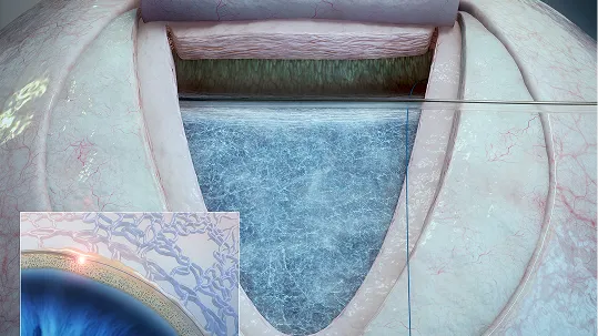 Ab Externo Procedure image