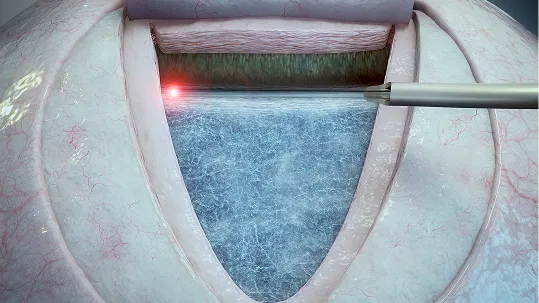 Ab Externo Procedure image