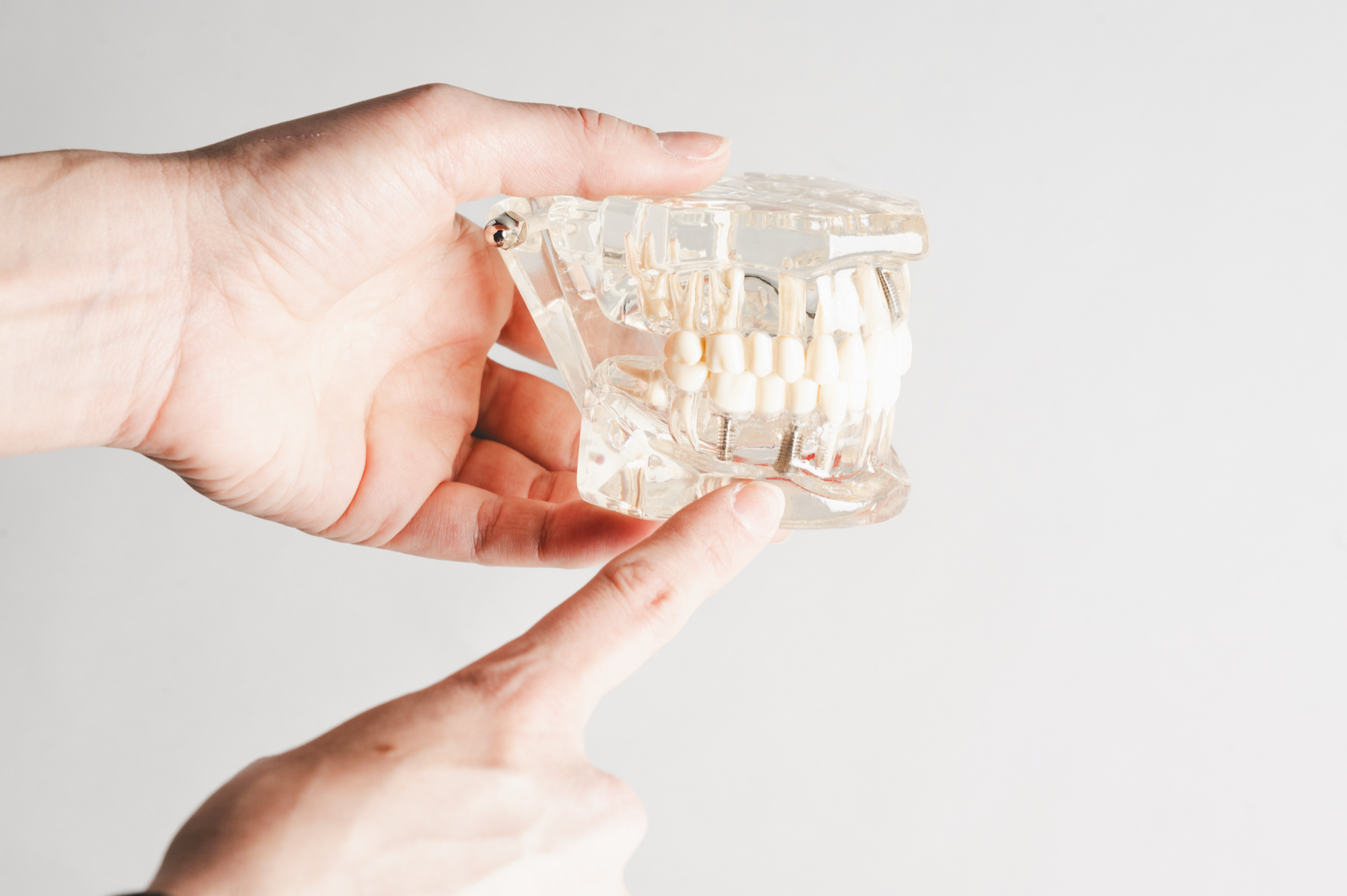Dentist holding dental implant model showing tooth replacement structure to patient