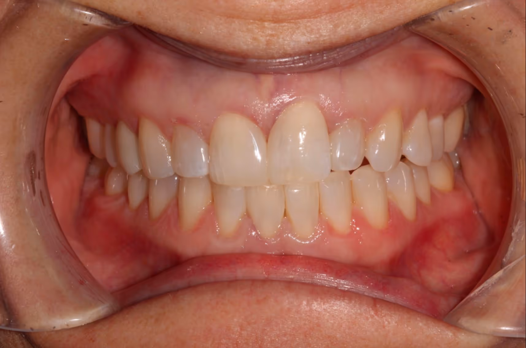 Smiling woman with wavy blonde hair holding a hand mirror, examining her teeth.