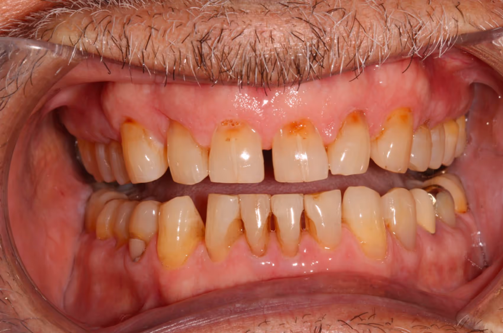 Smiling woman with wavy blonde hair holding a hand mirror, examining her teeth.