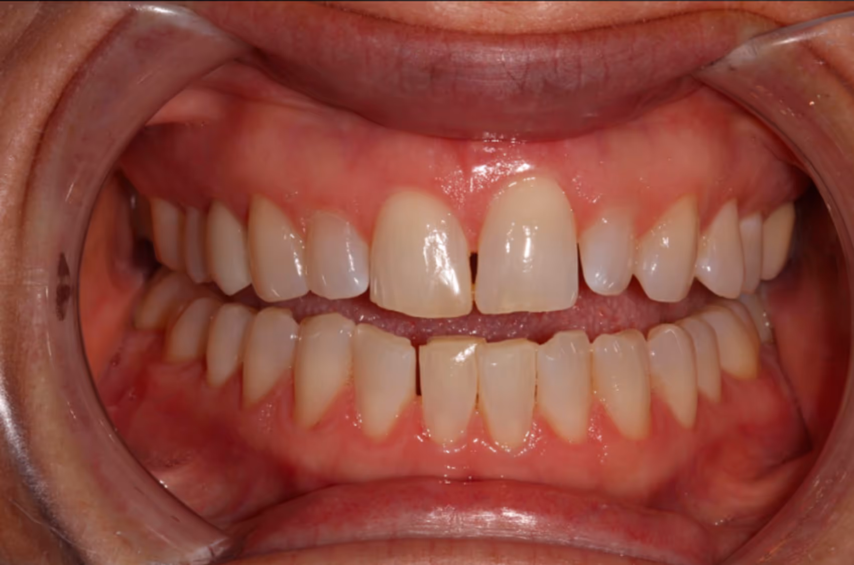 Smiling woman with wavy blonde hair holding a hand mirror, examining her teeth.