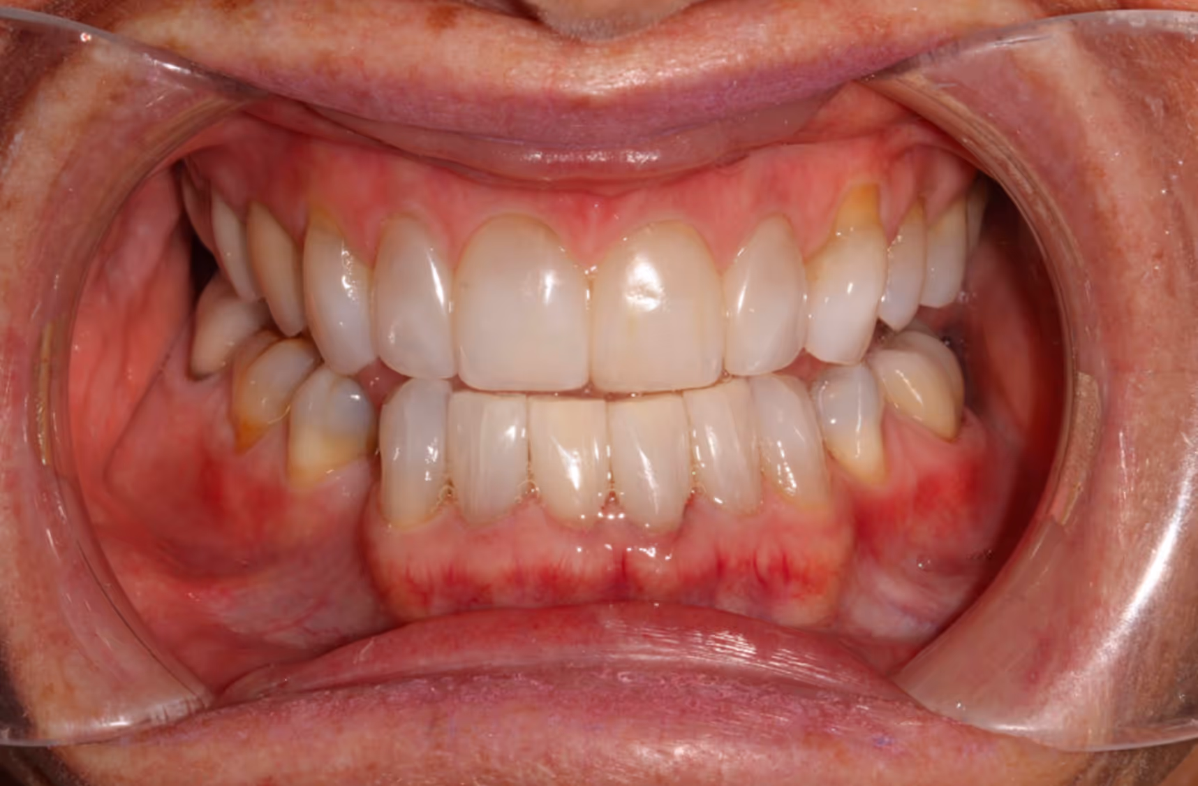 Smiling woman with wavy blonde hair holding a hand mirror, examining her teeth.