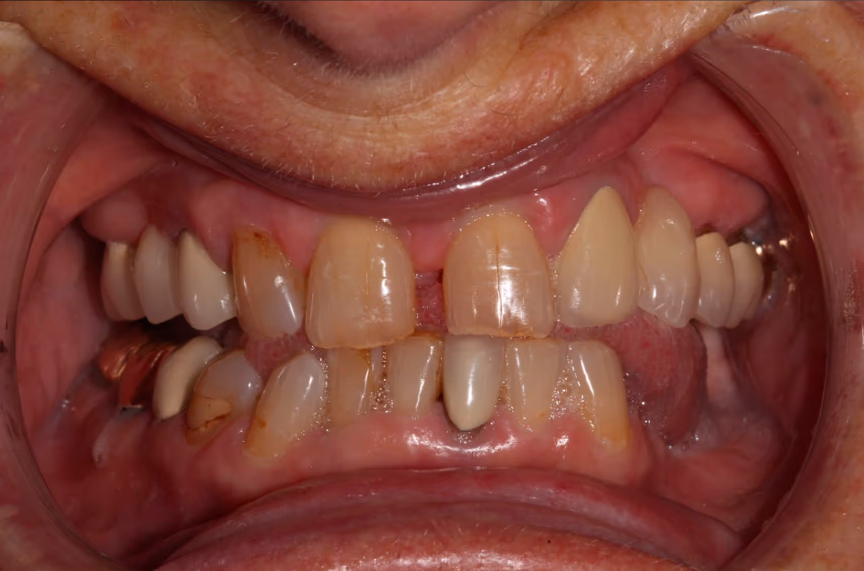 Smiling woman with wavy blonde hair holding a hand mirror, examining her teeth.