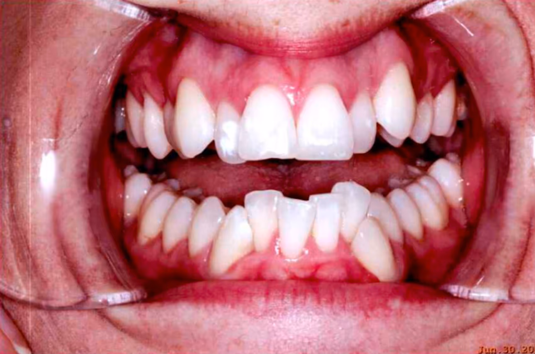 Smiling woman with wavy blonde hair holding a hand mirror, examining her teeth.