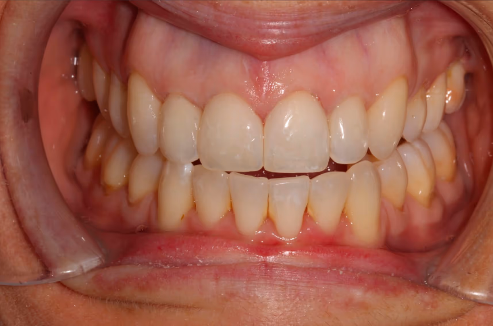 Smiling woman with wavy blonde hair holding a hand mirror, examining her teeth.