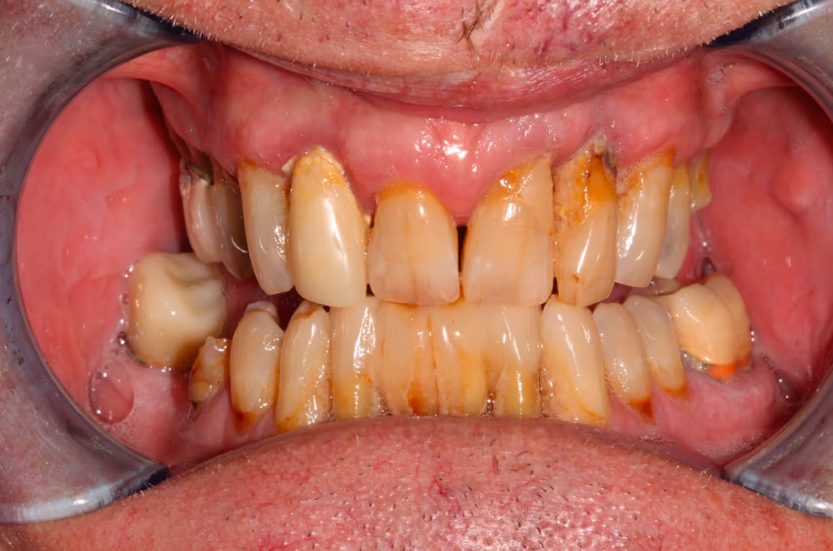 Smiling woman with wavy blonde hair holding a hand mirror, examining her teeth.