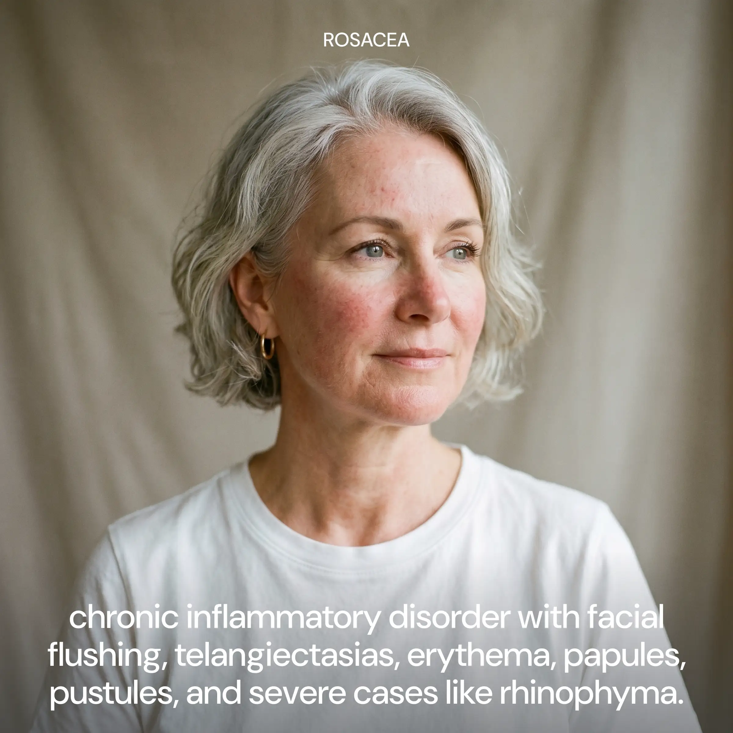 Rosacea Formula: Inflammation