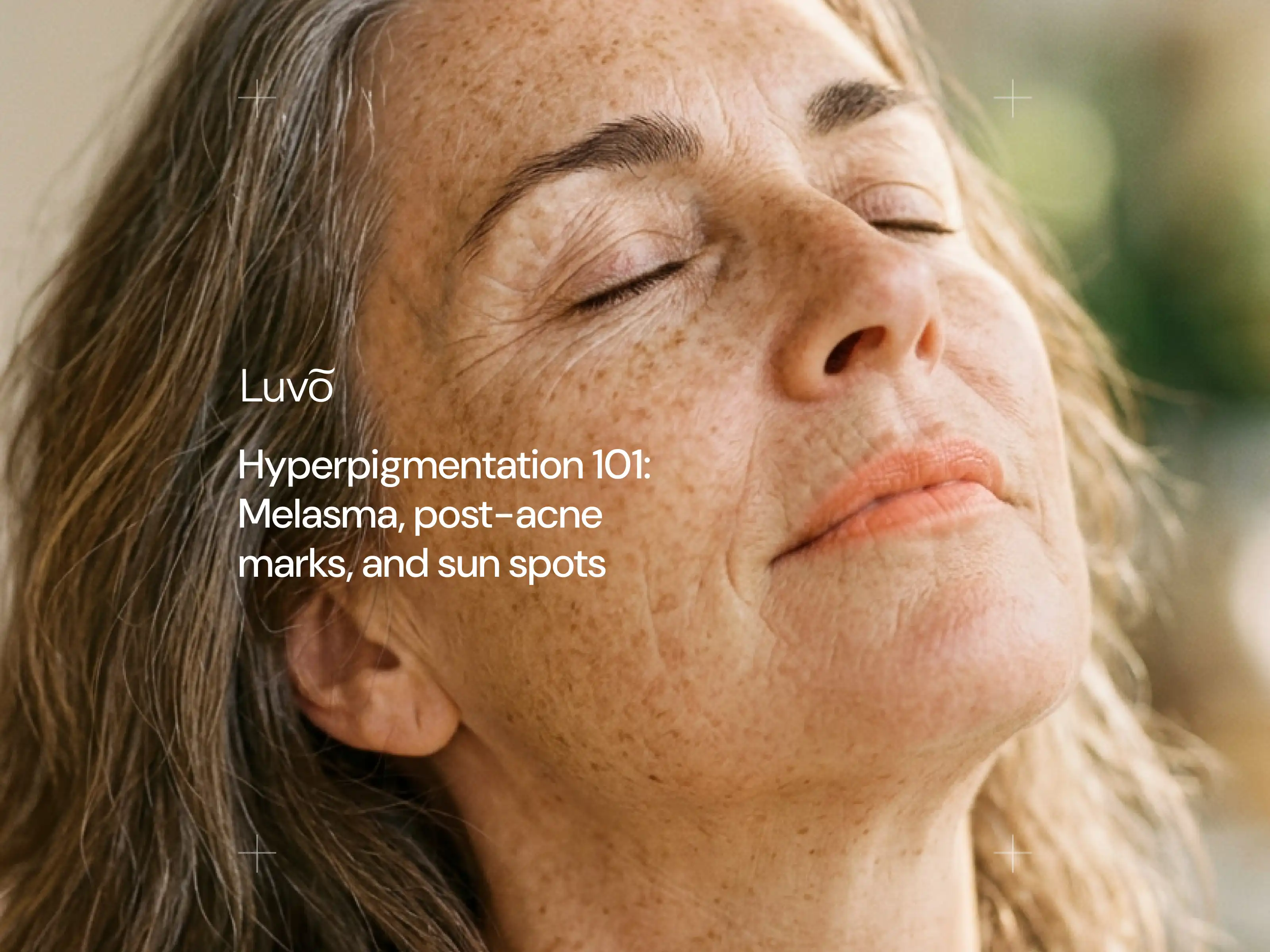 Hyperpigmentation 101: Melasma, post-acne marks, and sun spots