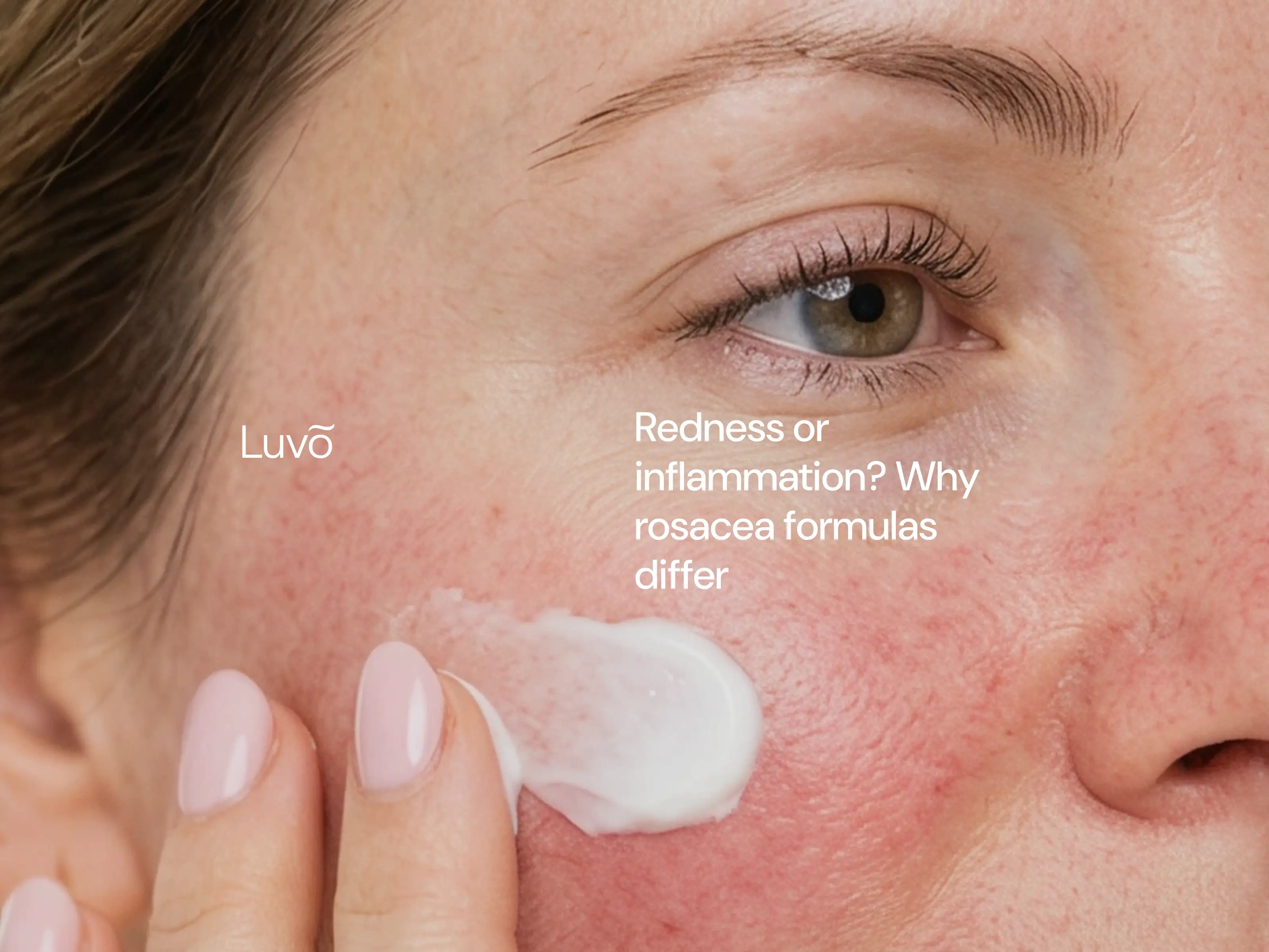 Redness or inflammation? Why rosacea formulas differ
