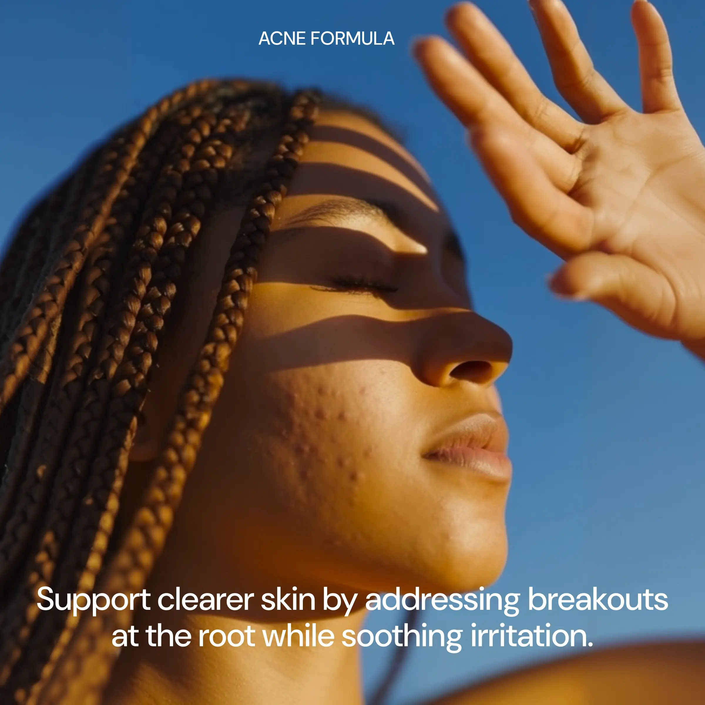 Acne Formula: Retinoid