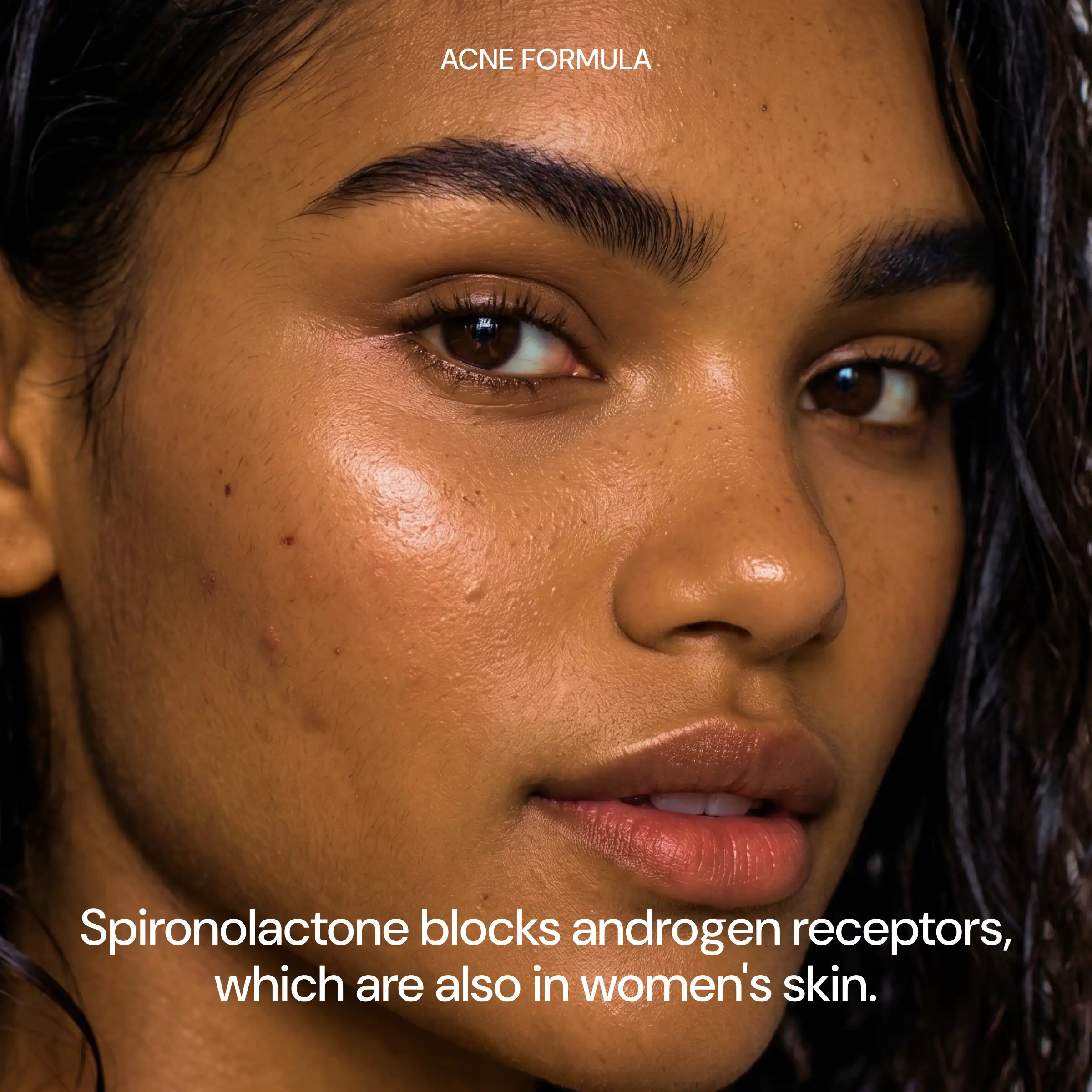 Acne Formula: Hormonal