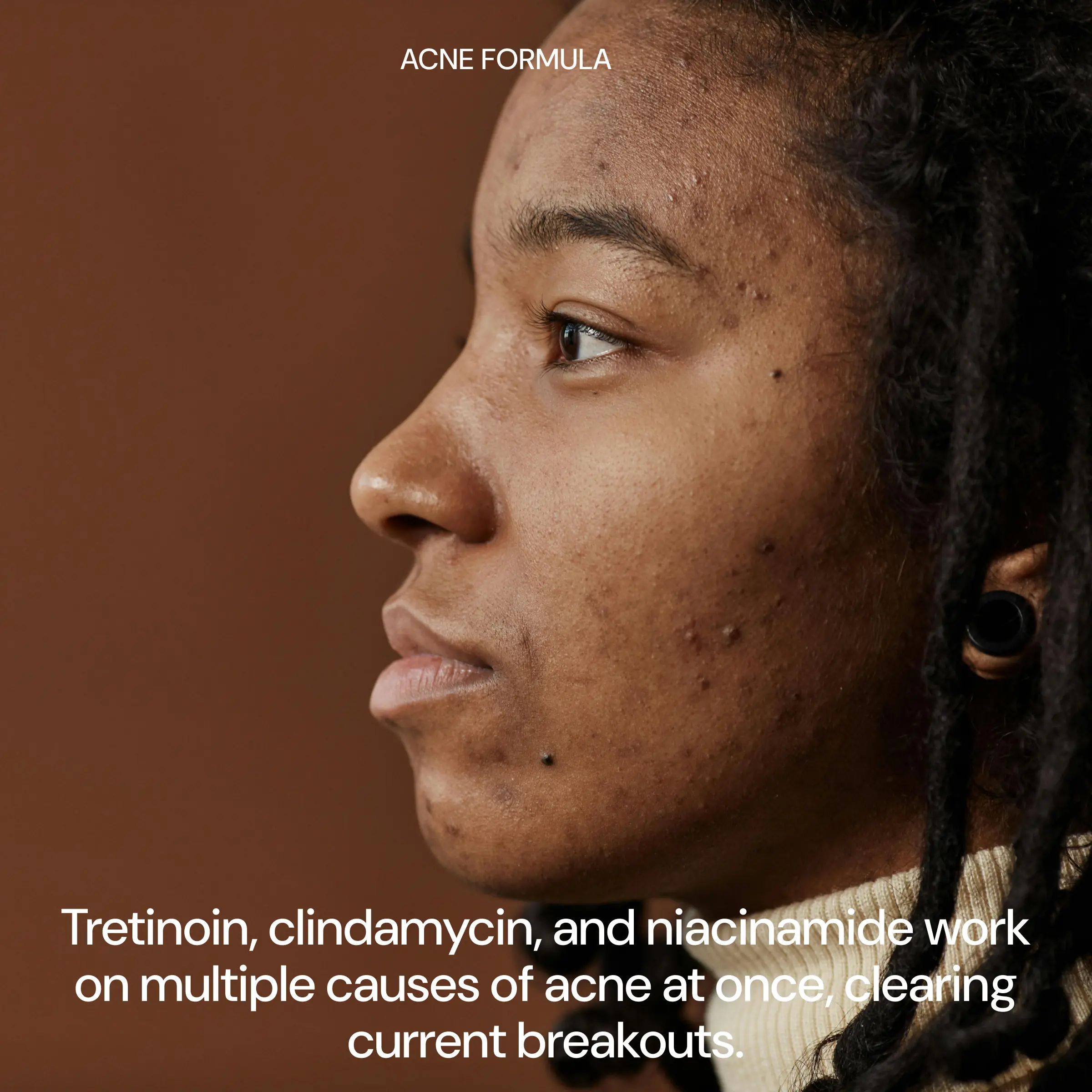 Acne Formula: Retinoid + Antibiotic