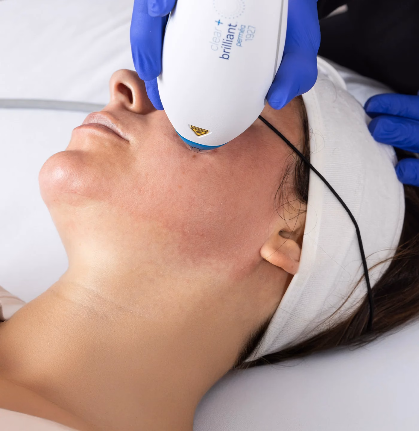 Clear Brilliant-R laser skin rejuvenation at a medspa in Greenwood, Colorado.
