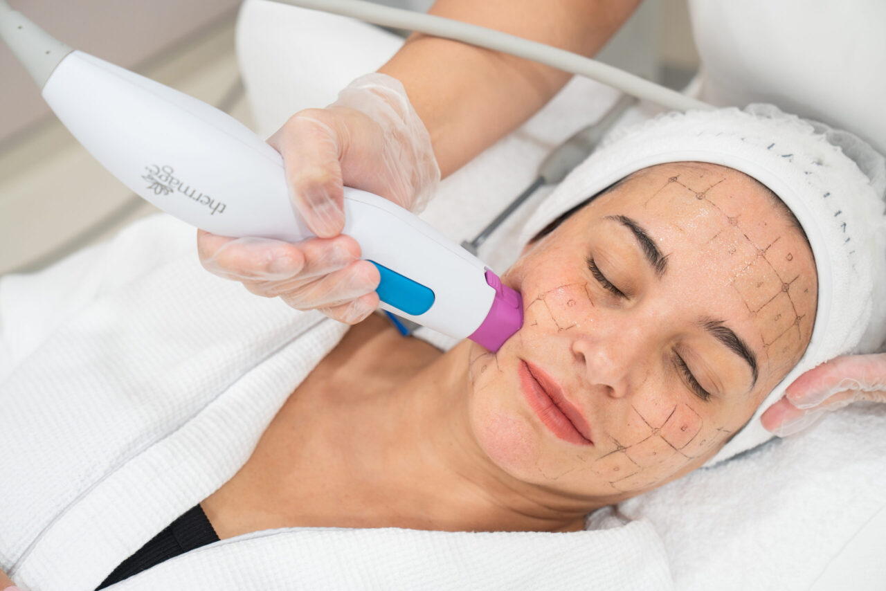 Thermage-R skin tightening treatment at a medspa in Greenwood, Colorado.