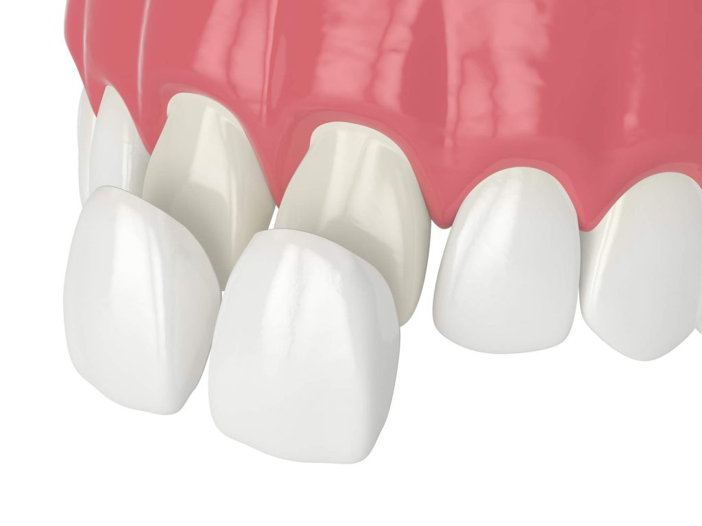 Looking for Veneers Orlando?