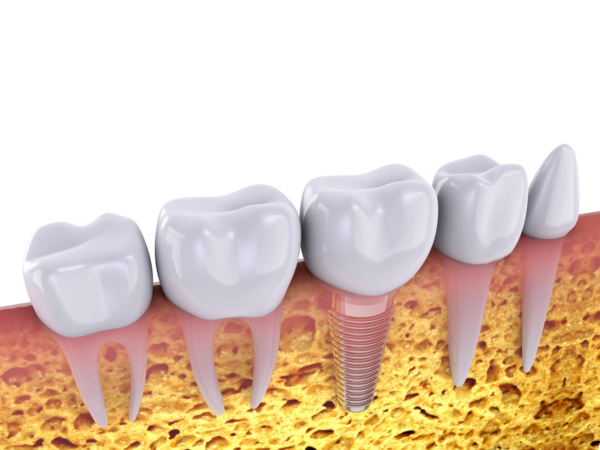 dental implants in orlando fl beside natural teeth