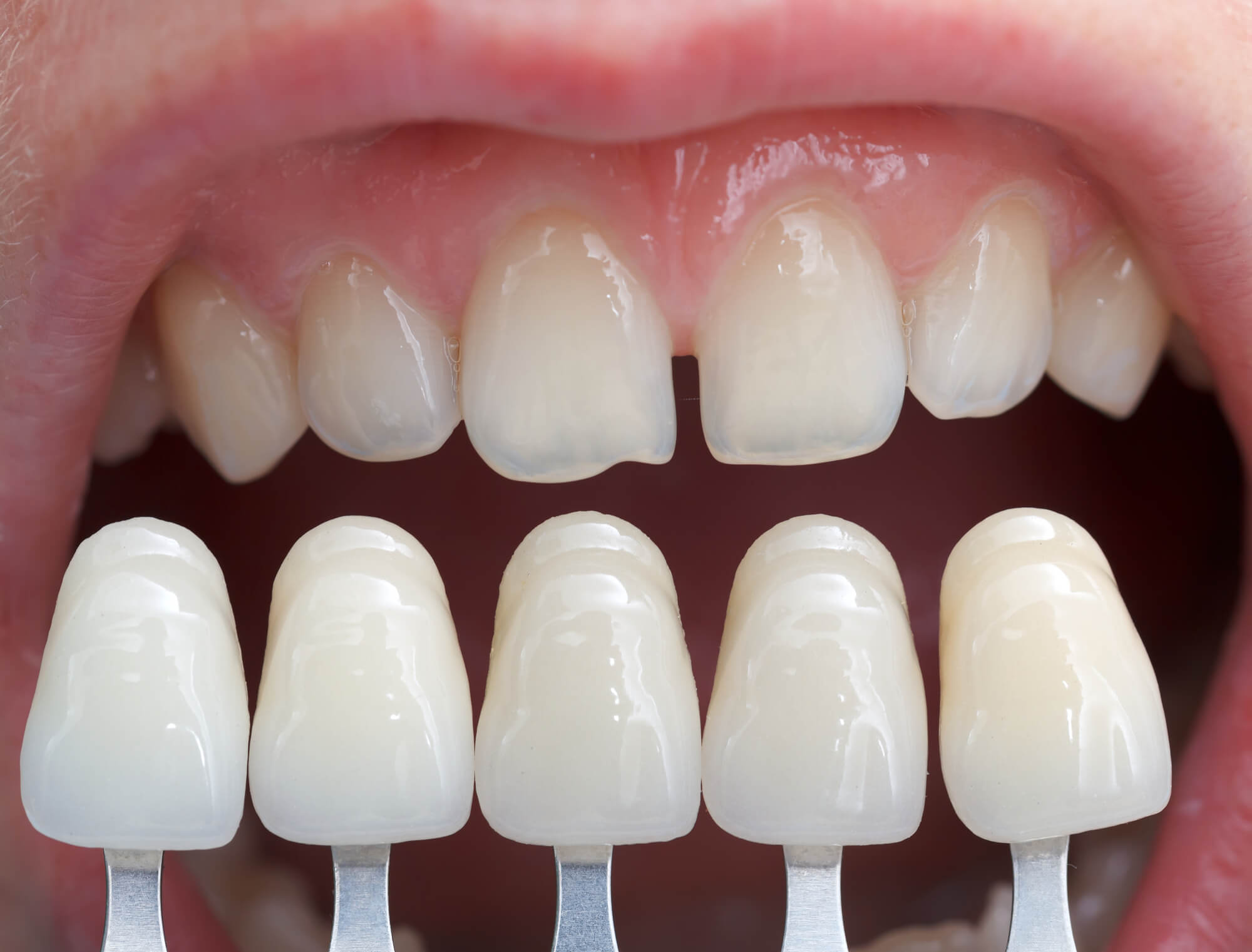 dentist choosing a shade for veneers orlando