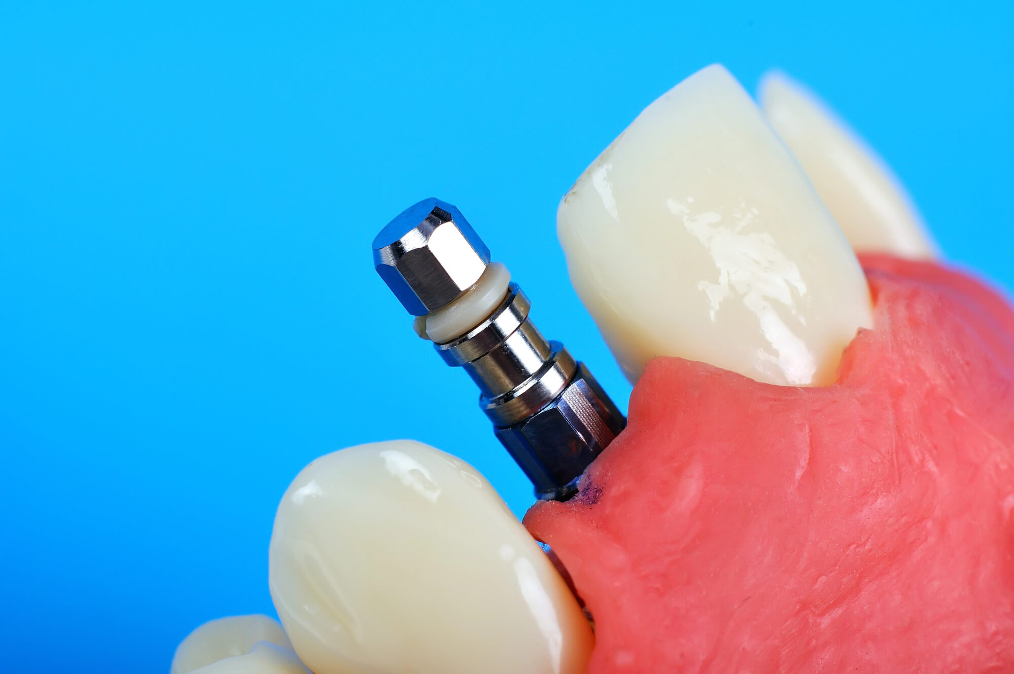 The Dynamic Duo: Dentures and Implants Redefining Dental Restorations    