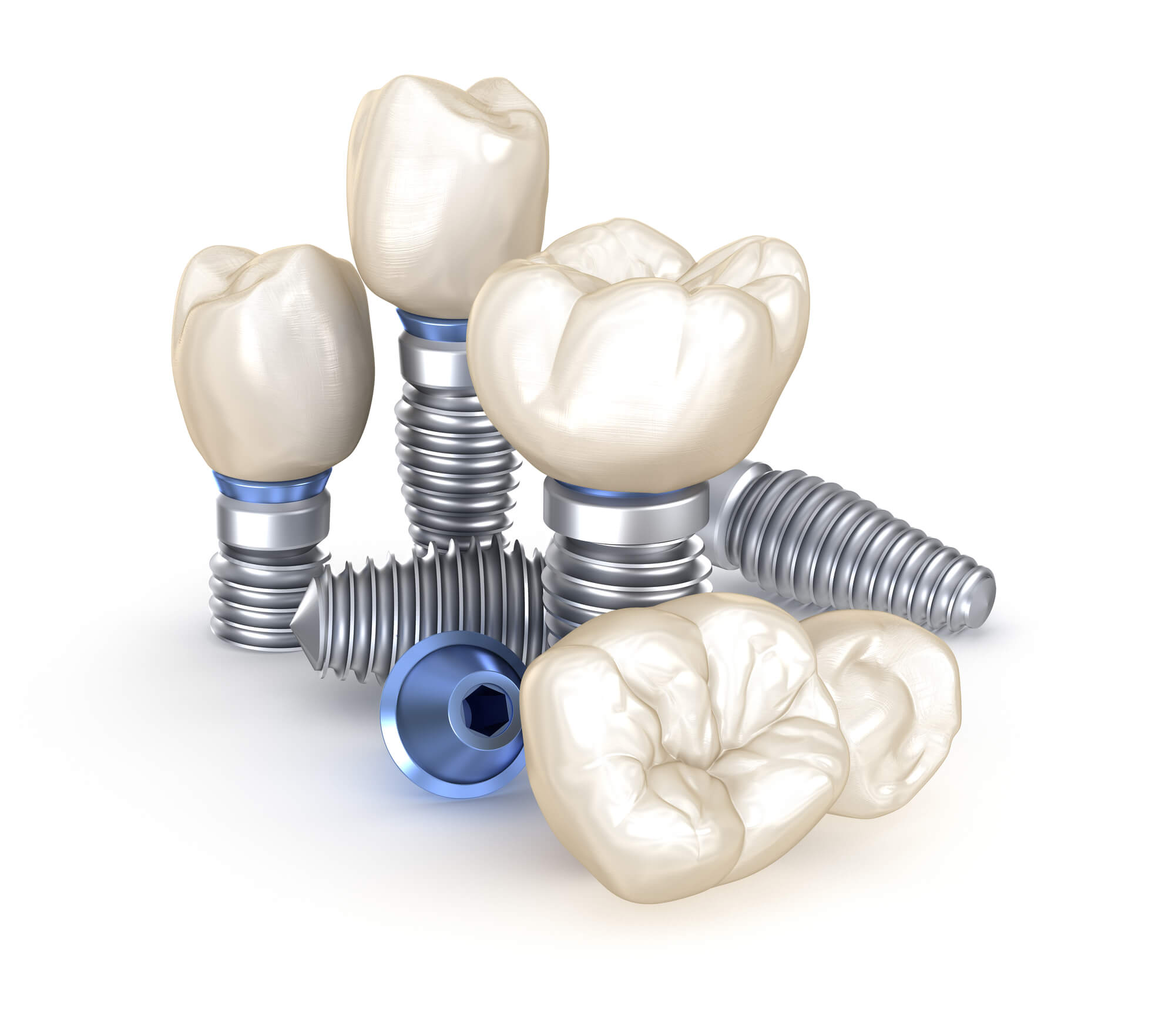 same day dental implants in Orlando