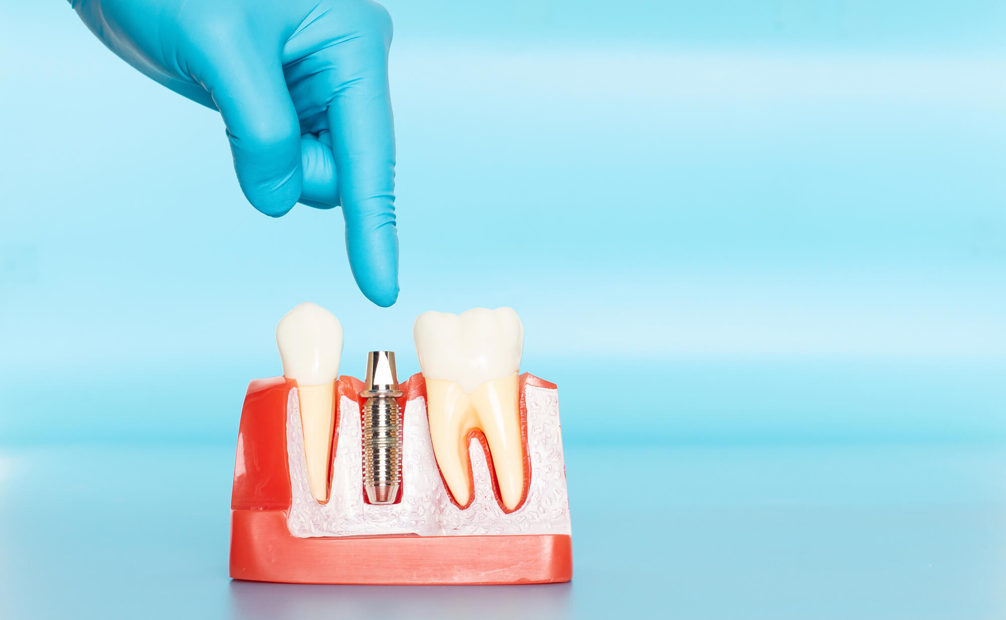 Factors That Influence the Cost of Dental Implants Explained