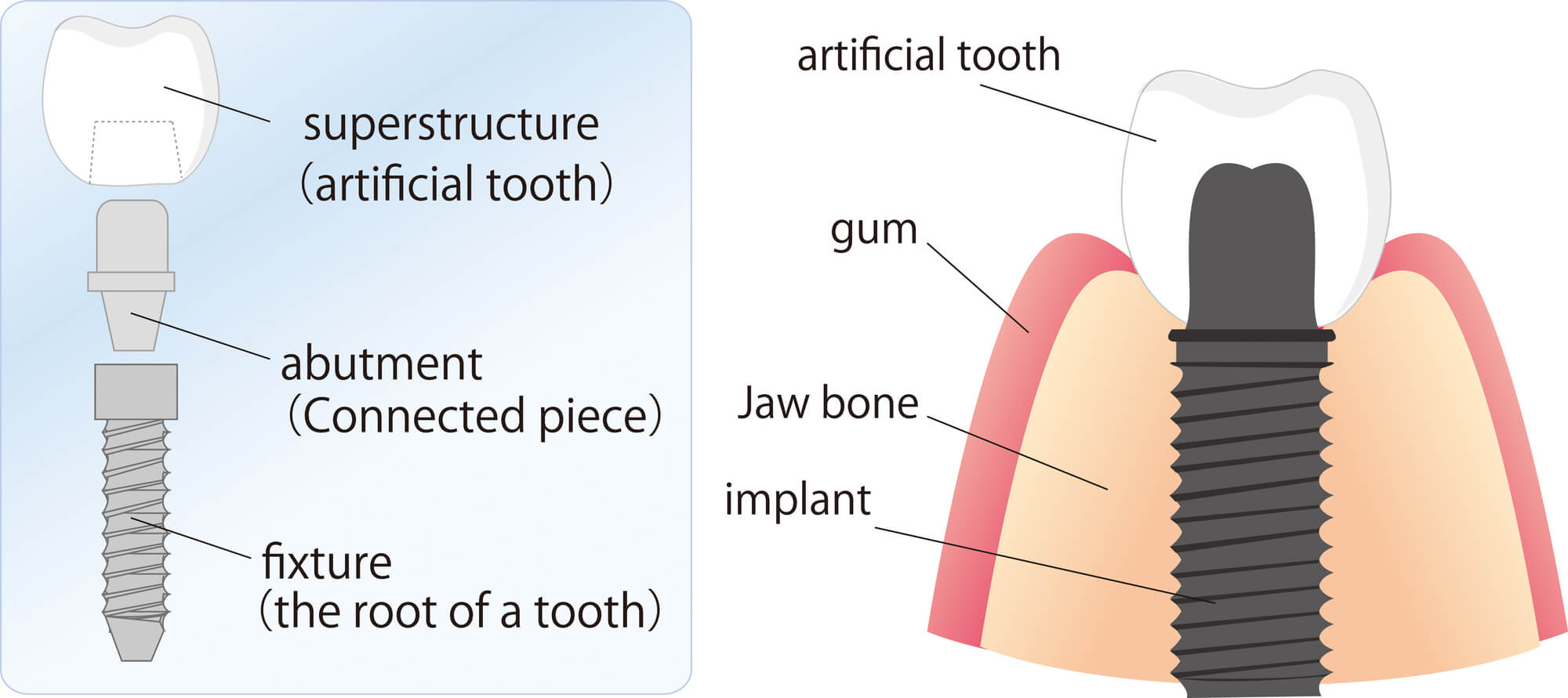 diagram of dental implant of implant dentist in Orlando