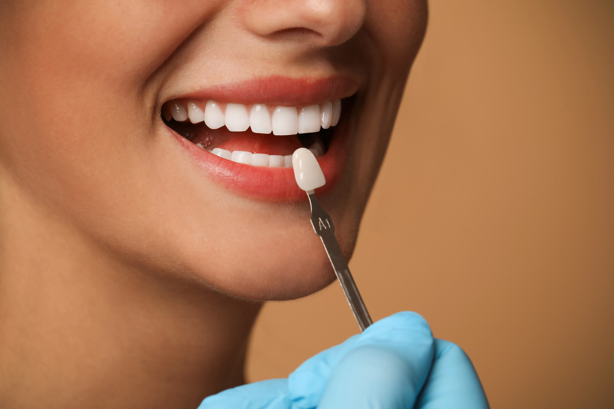Thinking About Veneers on Every Tooth? Here’s What to Know 