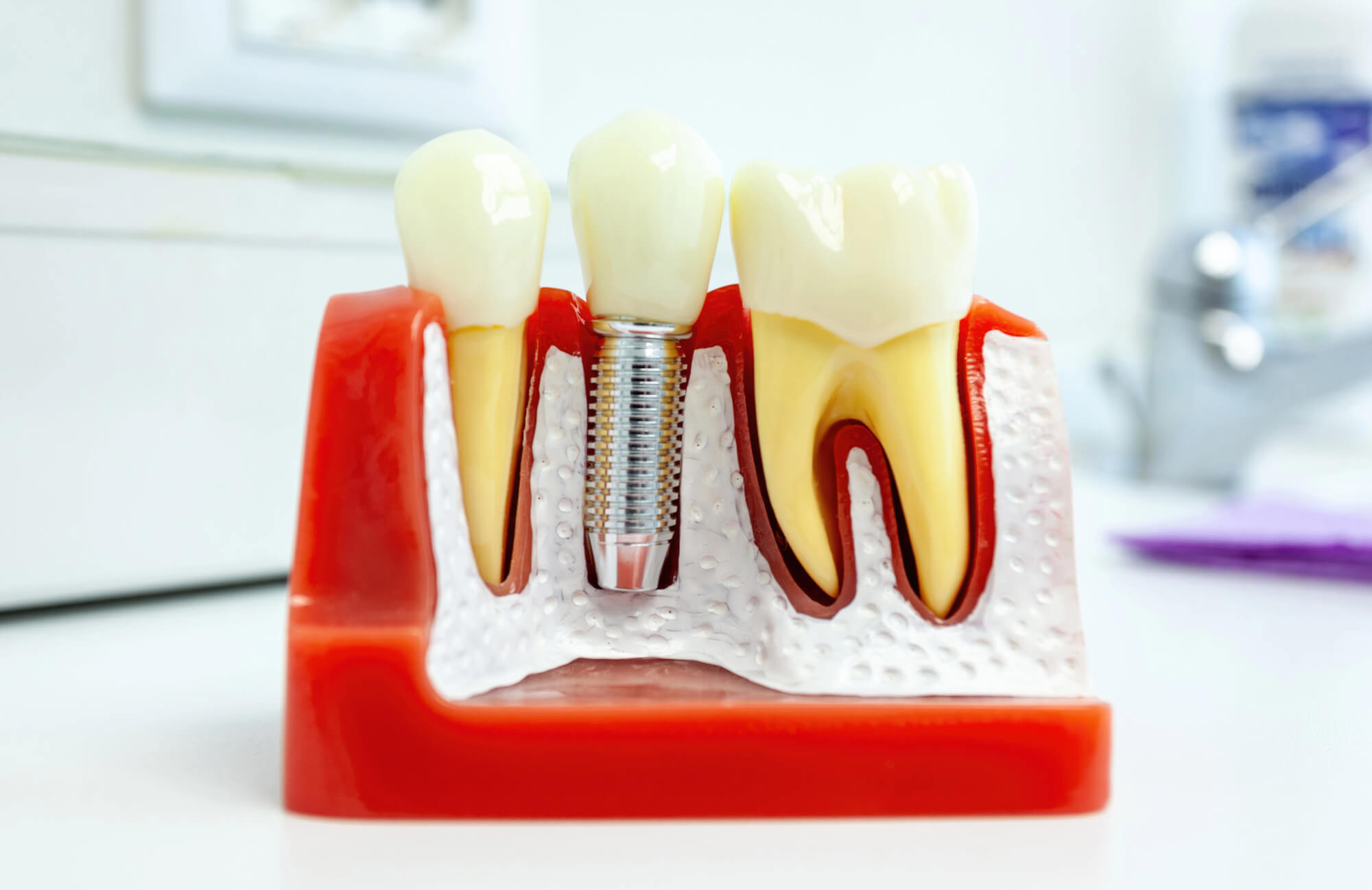 same day dental implants orlando model