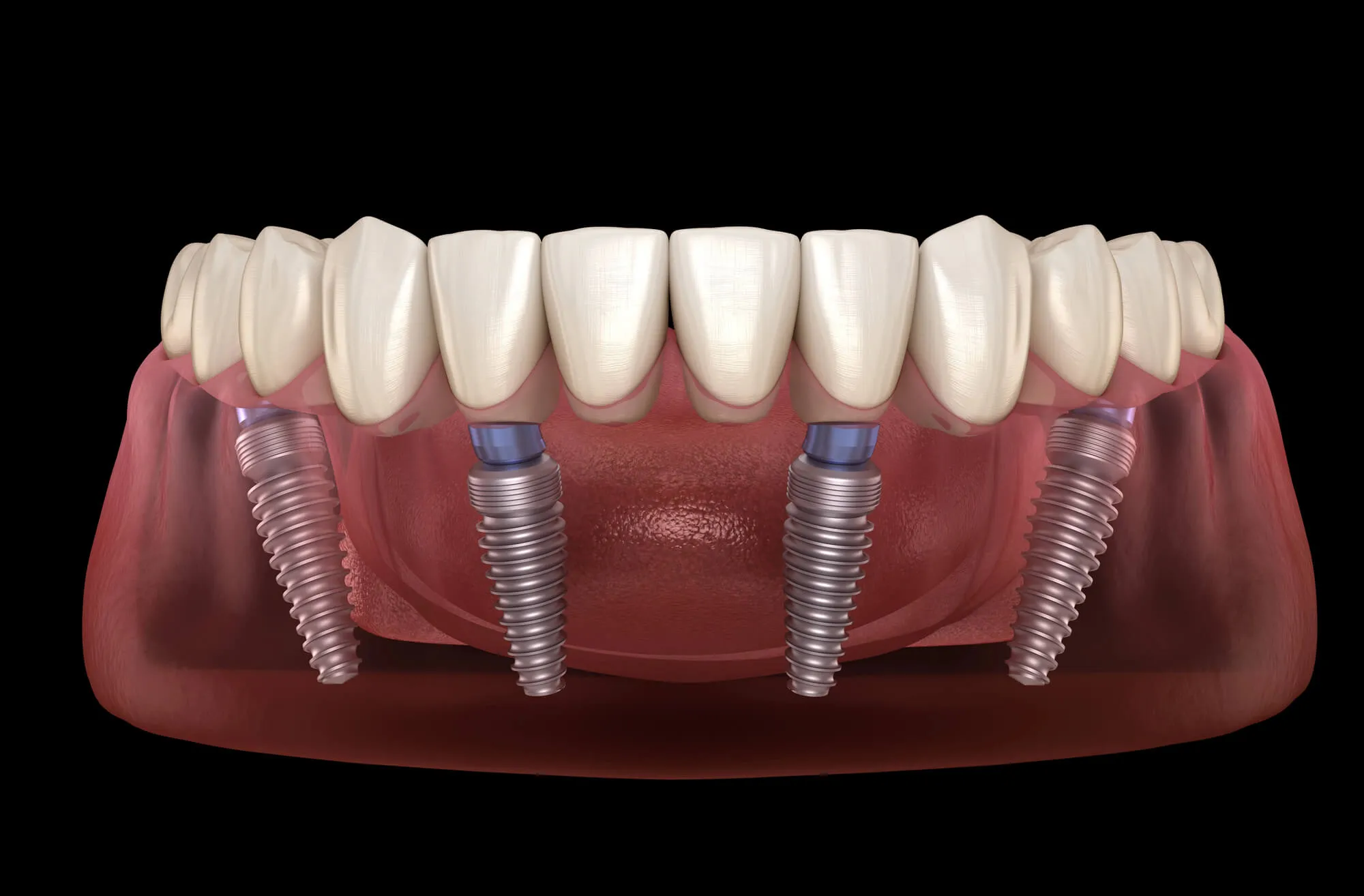 How Teeth in a Day Treatment Works from Consultation to Recovery