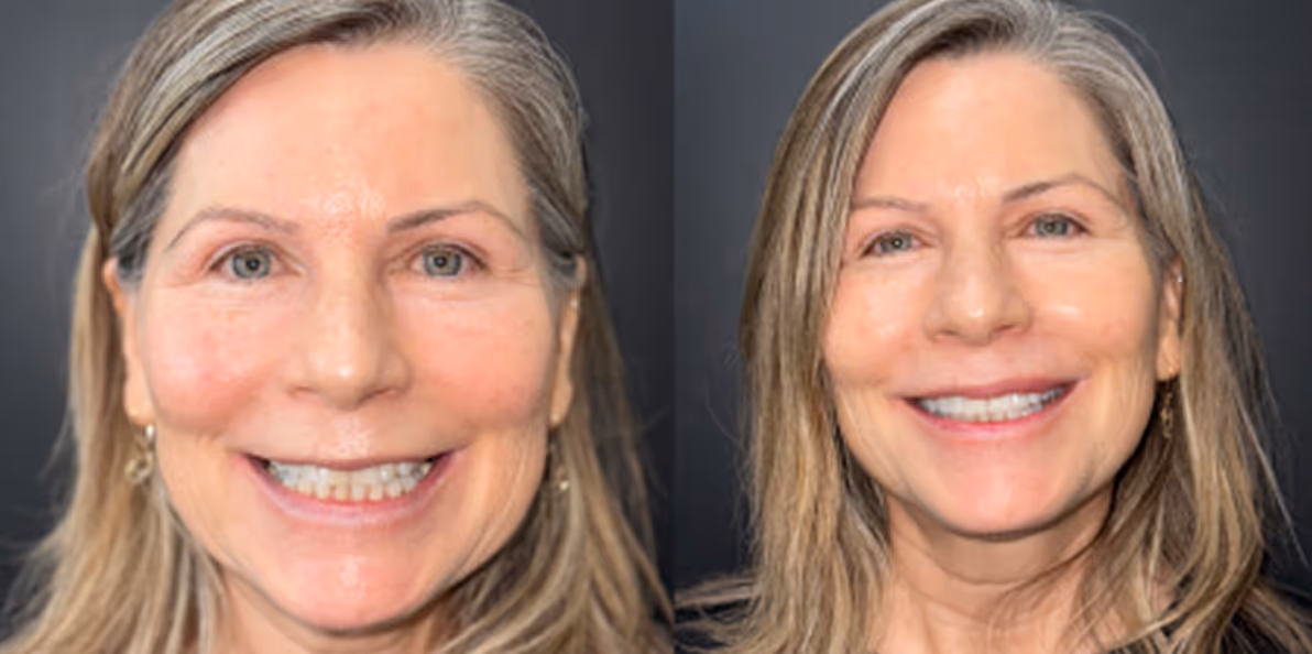Before and after porcelain veneers by Dr. Kate sahafi - Dovel Dental Newport Beach